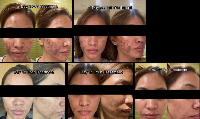 Facial skin reaction following microneedling treatment